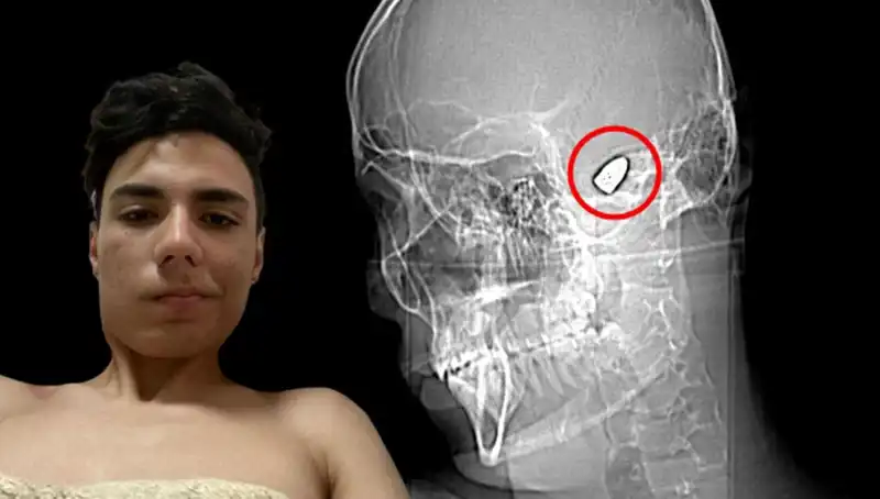 Kafasında Patlayıcı Bomba Taşıyan Adamın İnanılmaz Hikayesi